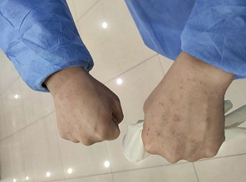 心疼!大连男护士的这双手